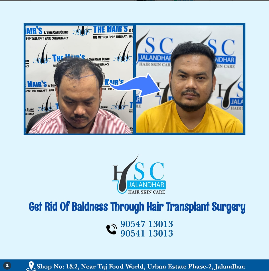 Best Hair Transplant In Jalandhar