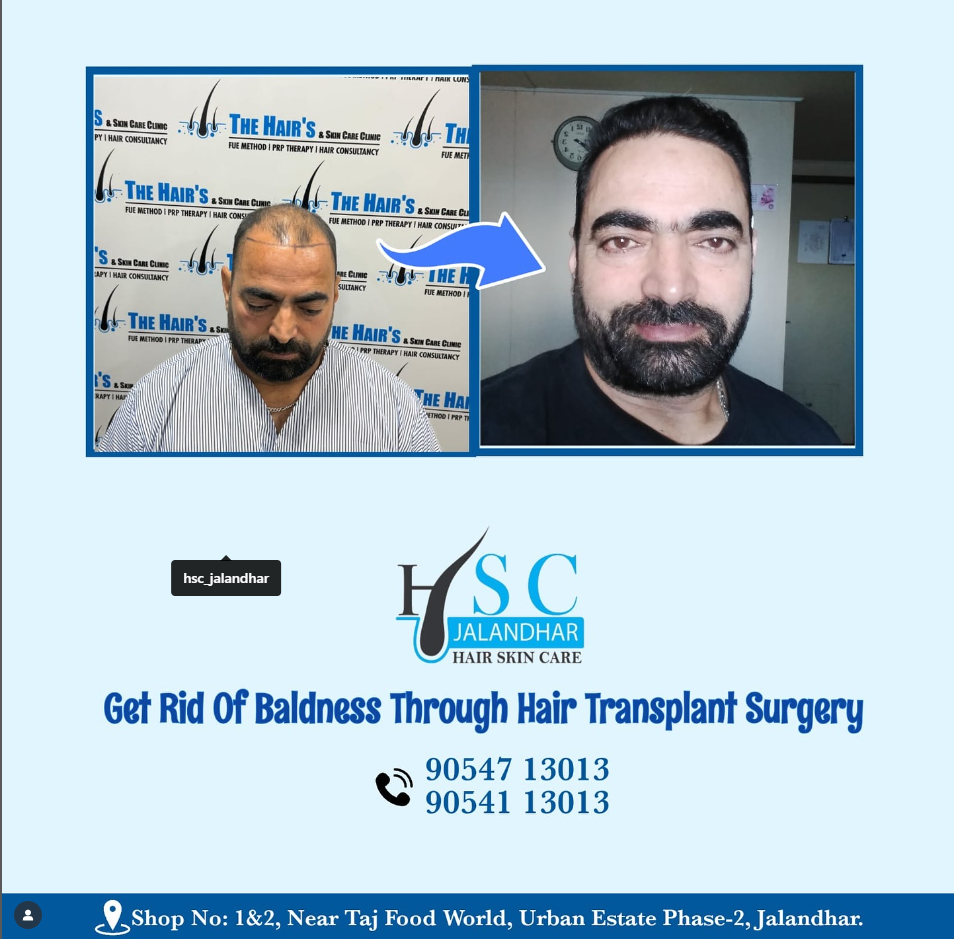 Best Hair Transplant In Jalandhar