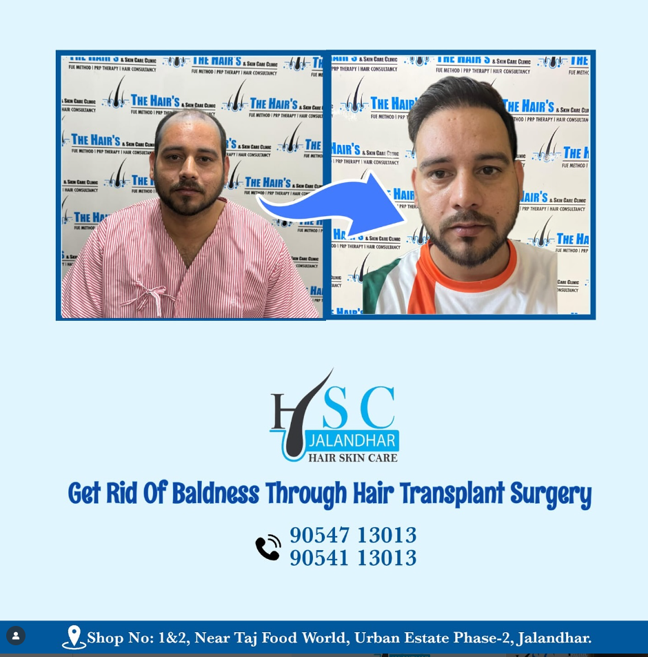Best Hair Transplant In Jalandhar