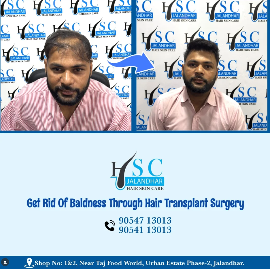 Best Hair Transplant In Jalandhar