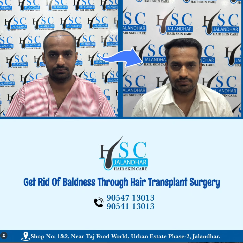 Best Hair Transplant In Jalandhar