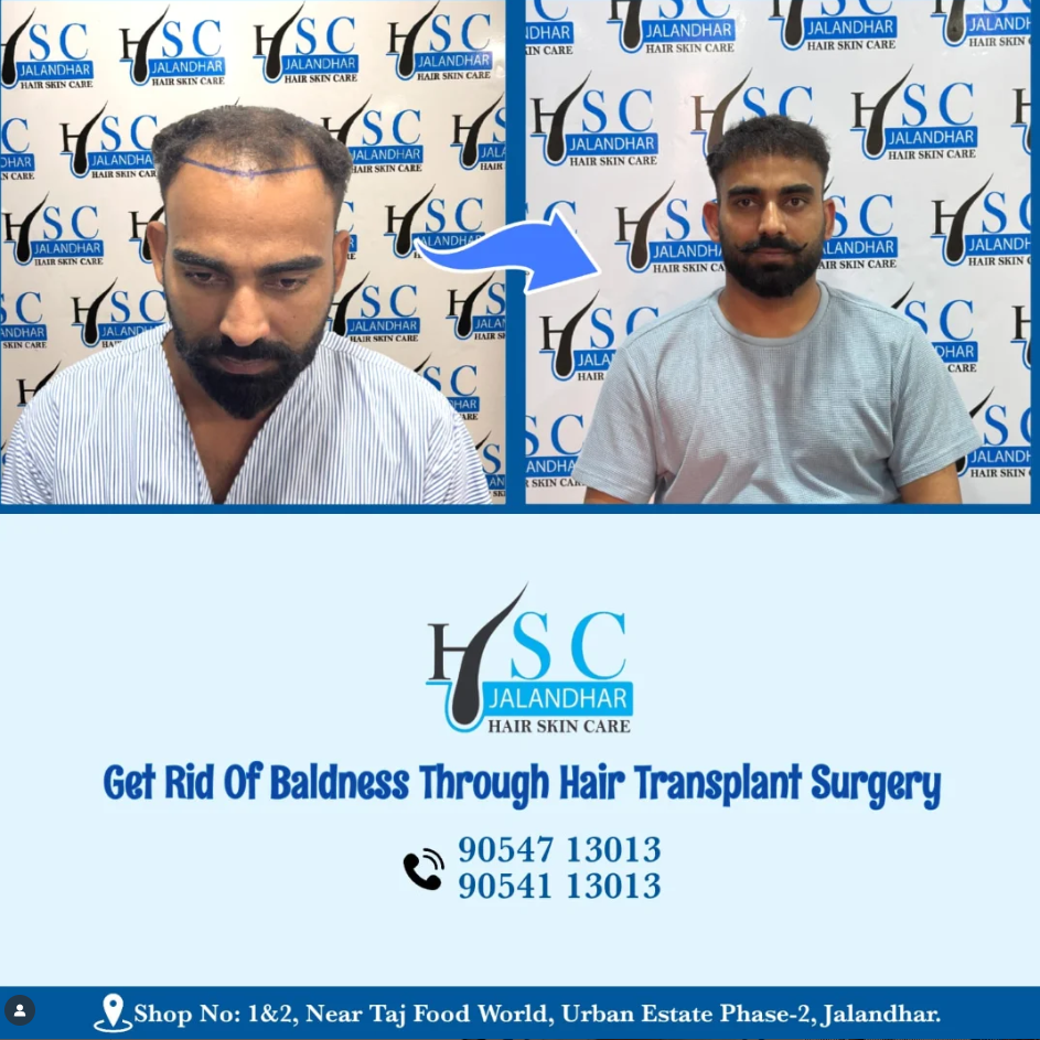 Best Hair Transplant In Jalandhar