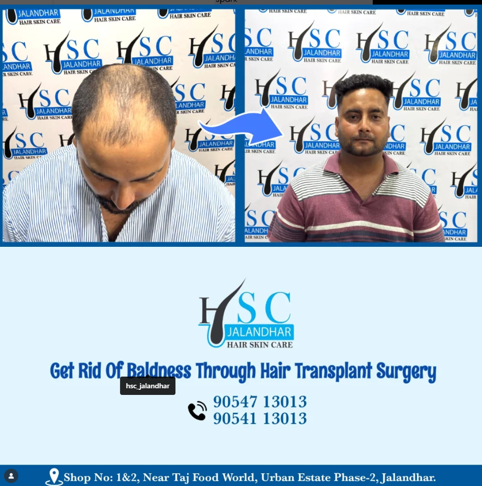 Best Hair Transplant In Jalandhar