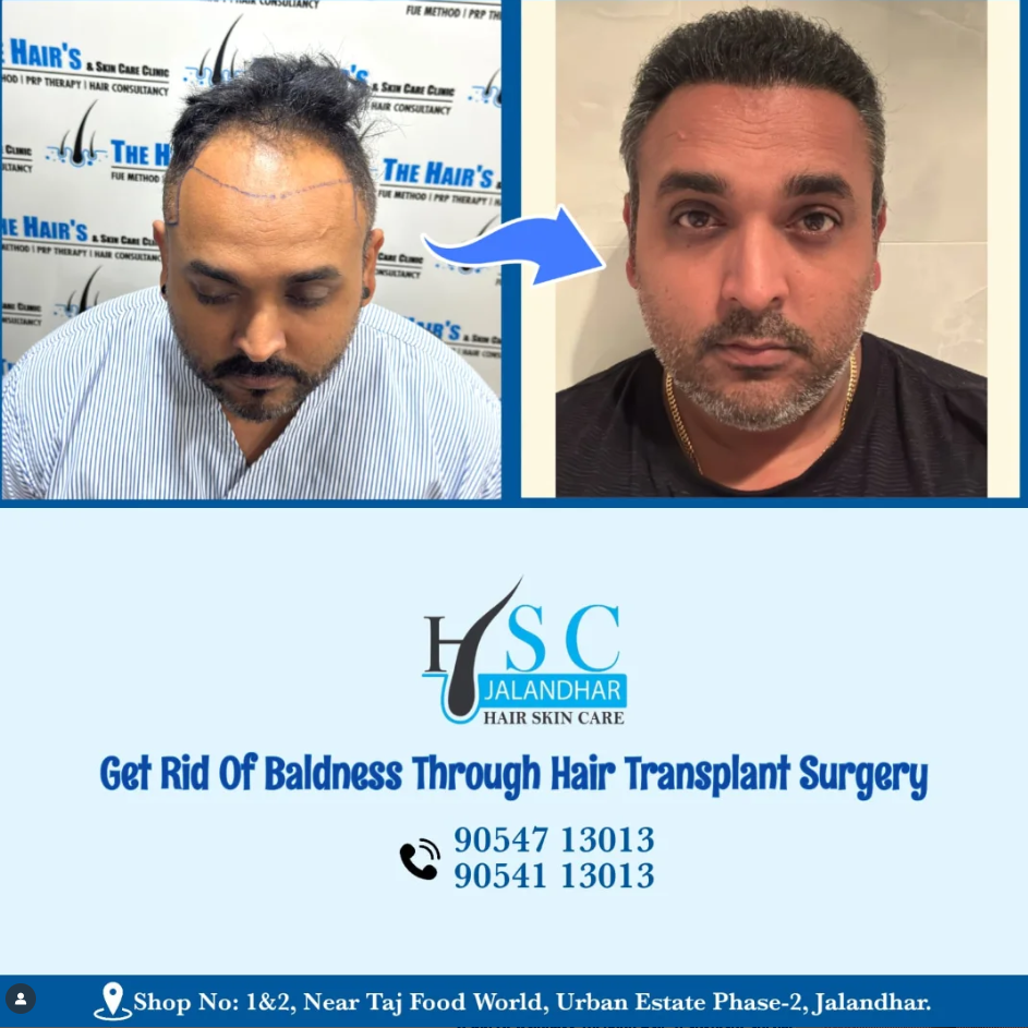 Best Hair Transplant In Jalandhar