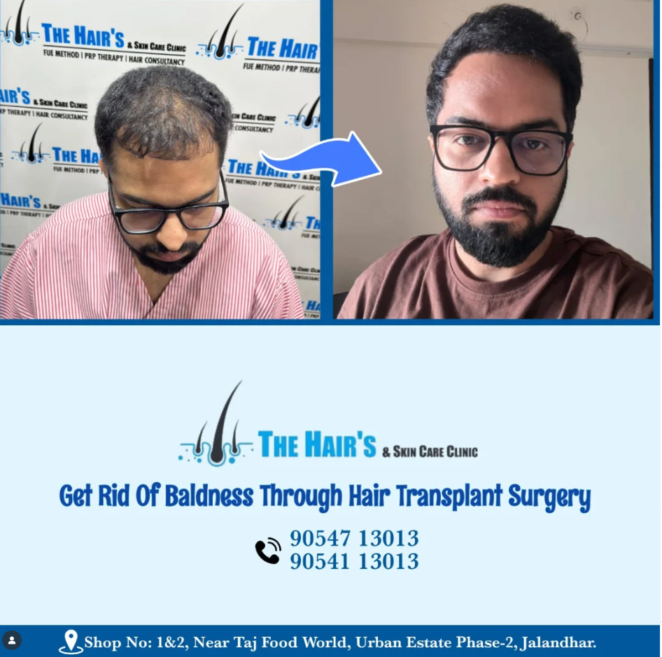 Best Hair Transplant In Jalandhar